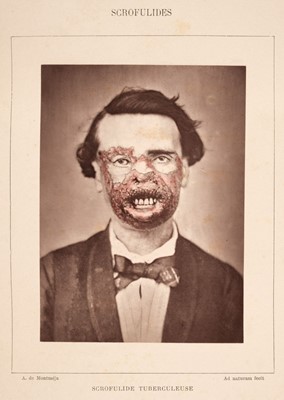 Lot 377 - Hardy (Alfred & De Montmeja, A.). Clinique photographique des maladies de la peau, 1882
